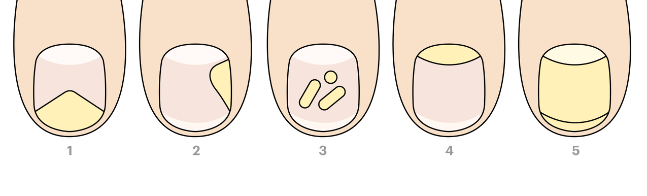 kāju nagu sēnīšu veidi